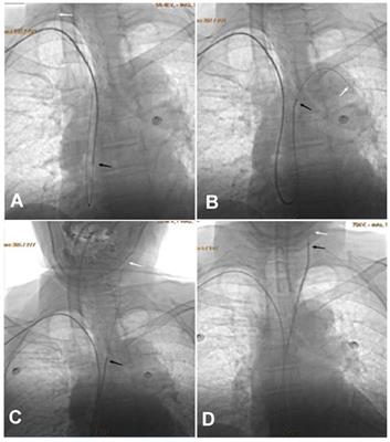 Transradial intra-aortic catheter looping in the angioplasty of severe intracranial symptomatic arteriosclerotic diseases